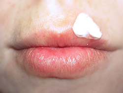 Lippenherpes wird meist mit antiviralen Cremes zur äußeren Anwendung behandelt.